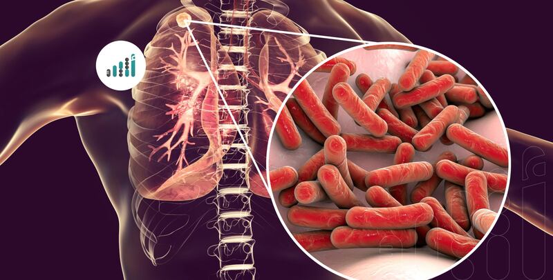 أكثر من 10 مليون إصابة جديدة بالسلّ خلال عام 2024، فماذا هي أعراضه؟
