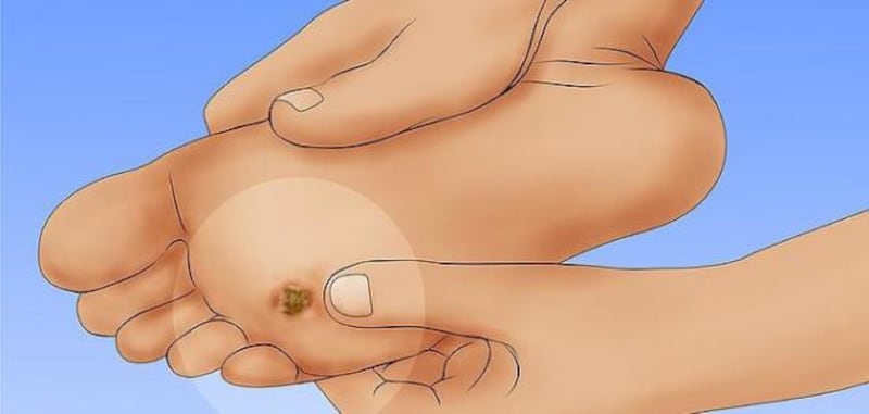 إذا كنت تعاني من مسمار القدم؛ إليك أسبابه وطرق علاجه