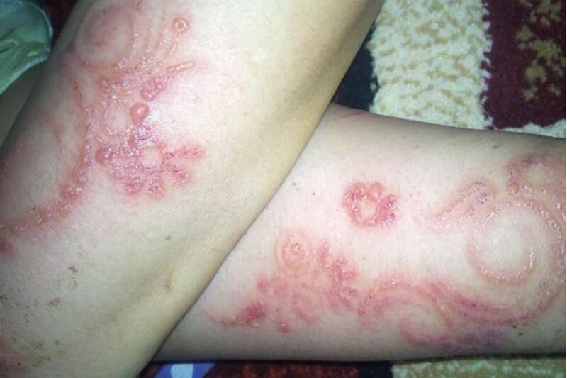 للنساء: احذَرن الحناء السوداء ففيها مادة سامة