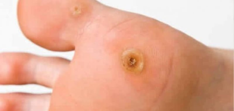 إذا كنت تعاني من مسمار القدم؛ إليك أسبابه وطرق علاجه