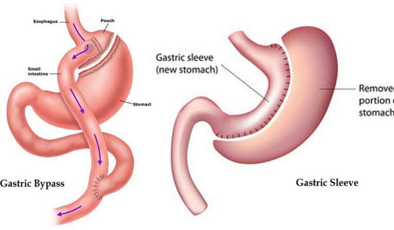 إذا كنت محتارًا بين تحويل مسار المعدة وتكميم المعدة، إليك بعض المعلومات عنهما