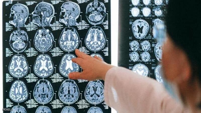 بشرى جديدة لمرضى الزهايمر
