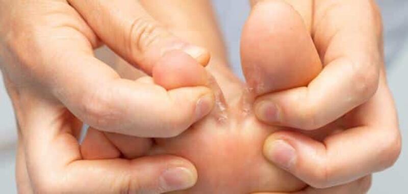 دكتور يُرشدك إلى كيفية تجنّب سعفة القدم