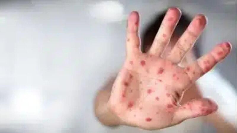 الصحة تُعلّق حول مستجدات جدري القردة