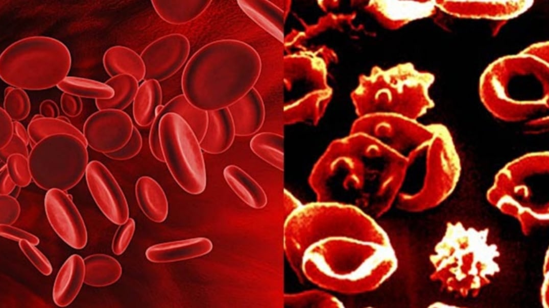 أخصائية تكشف عدد المصابين بالثلاسيميا في السلطنة…واختصاصية توضح أهمية الفحص قبل الزواج