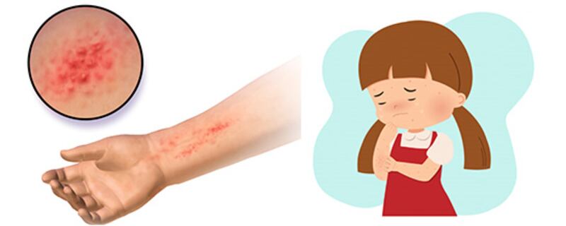 قد تصيبك أنت أو أحد أطفالك: تعرف على الإكزيما وأعراضها وطرق علاجها