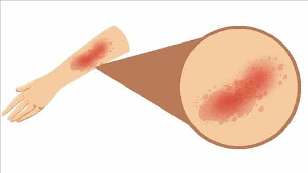 قد يستمر لسنوات وينتشر بين النساء: ماذا تعرف عن مرض الشرى؟