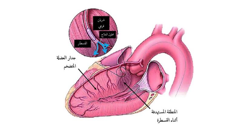 لأول مرة في السلطنة: علاج باستخدام تقنية جديدة