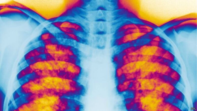 ما هو مرض التليف الكيسي؟