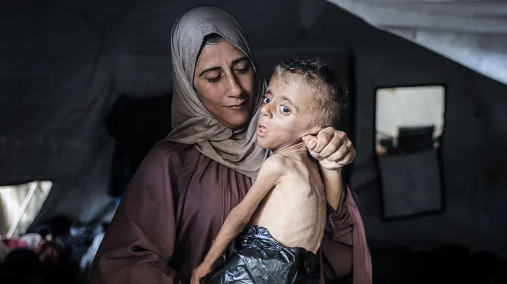 تحذير أممي: سوء التغذية الحاد يهدد حياة 9 آلاف طفل في غزة