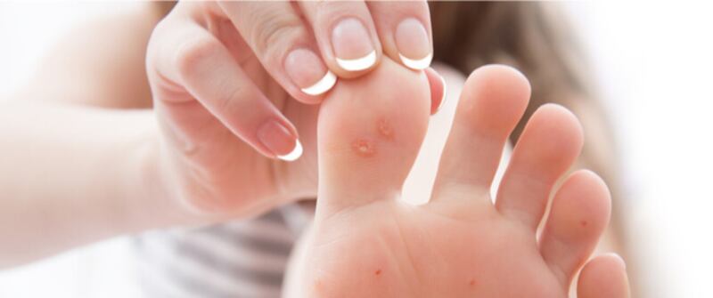 إذا كنت تعاني من مسمار القدم؛ إليك أسبابه وطرق علاجه