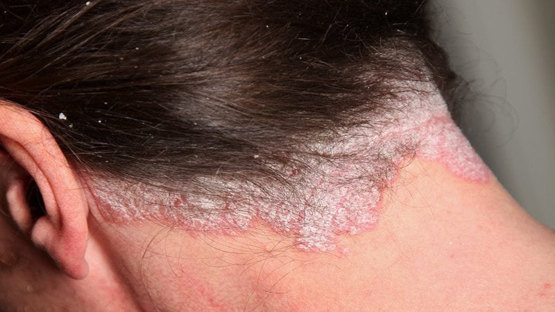 الصدفية مرض جلدي مزمن له 7 أنواع؛ تعال نعرفك عليها