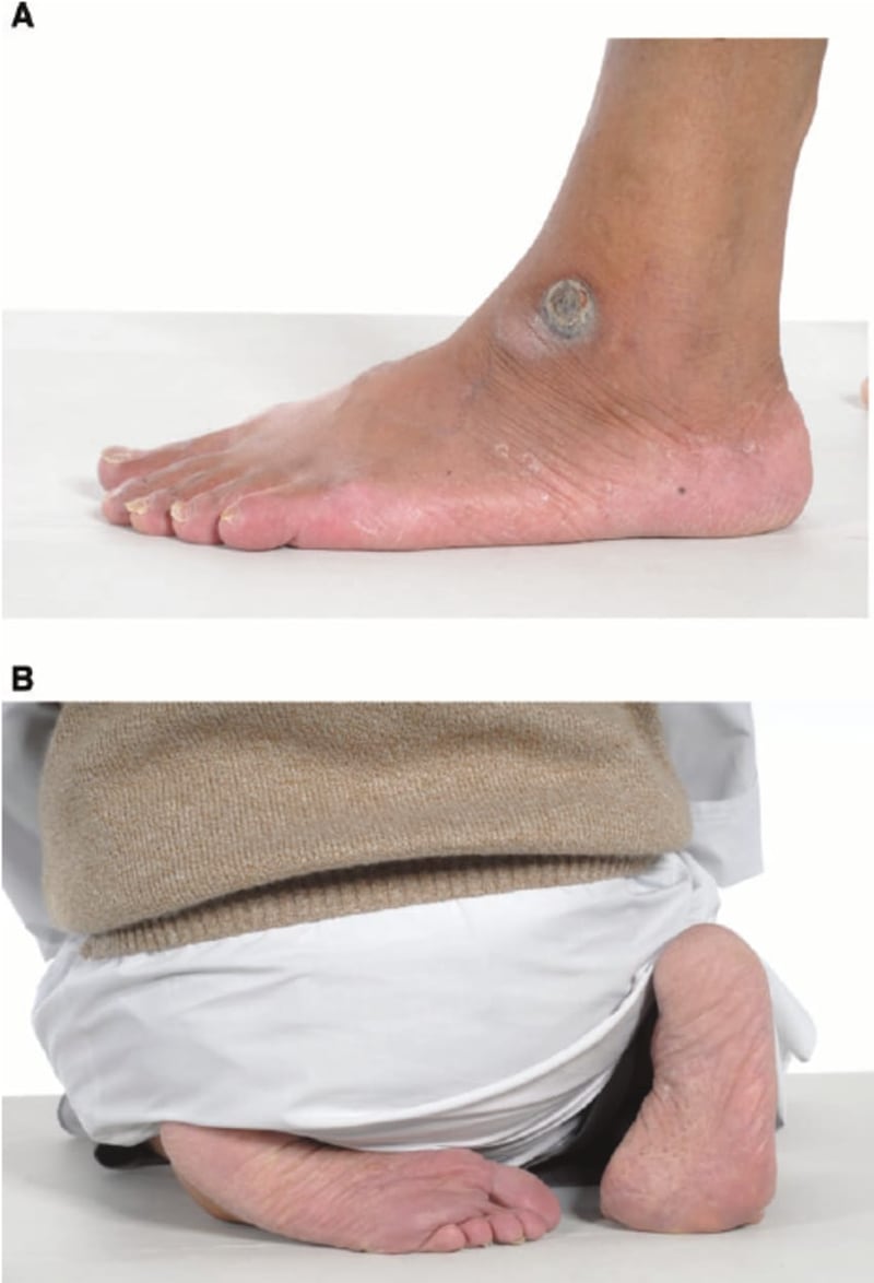 لمن يعاني من اسوداد جوزة القدم: إليك الأسباب وطرق الوقاية منه طبيًا