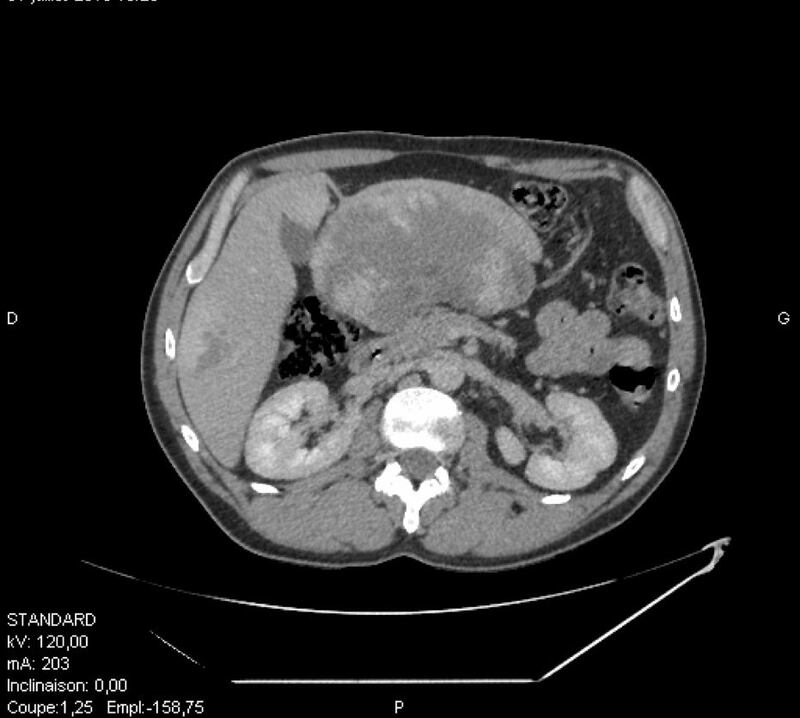 بها ورم صُنّف الأكبر عالميًا : جراح عُماني يشارك فريقًا متخصصا في تشخيص حالة نادرة جدا