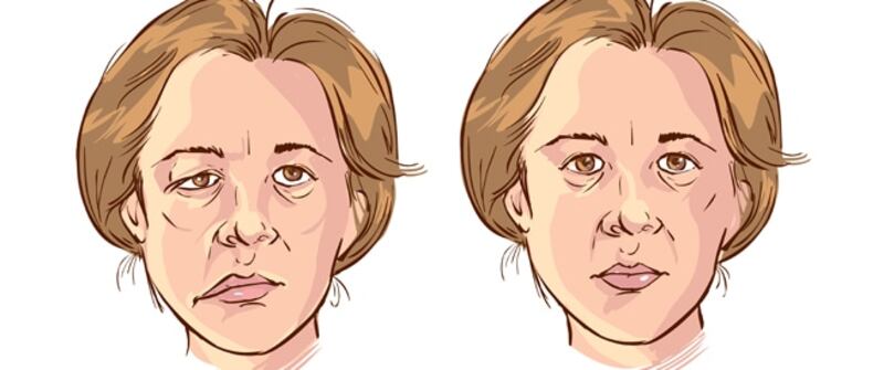 انتبه لهذه الأعراض؛ فقد تكون علامة على شلل العصب الوجهي