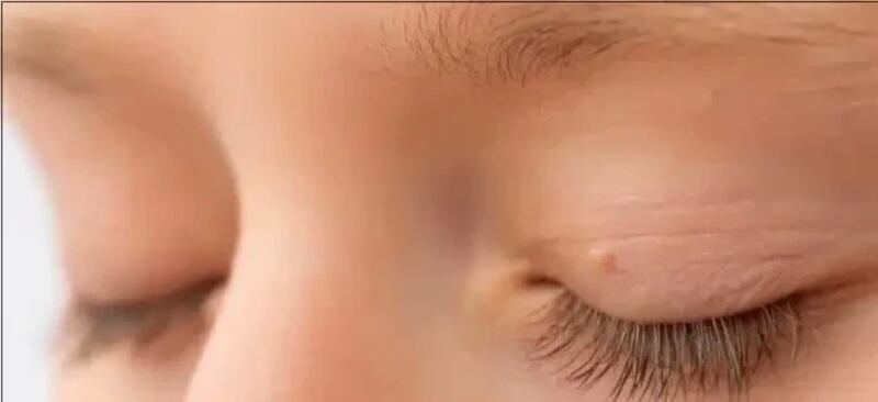 لماذا عليك عدم إهمال الزوائد الجلدية حول عينيك؟
