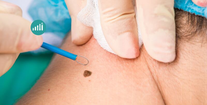 5 علامات تدل على أن الشامات خطرًا على صحتك