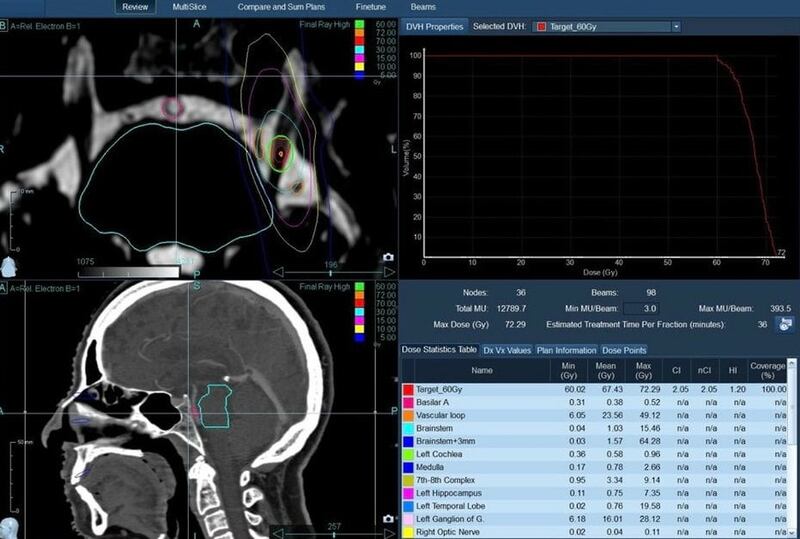 إجراء أول عملية إشعاعية للعصب الدماغي في سلطنة عمان
