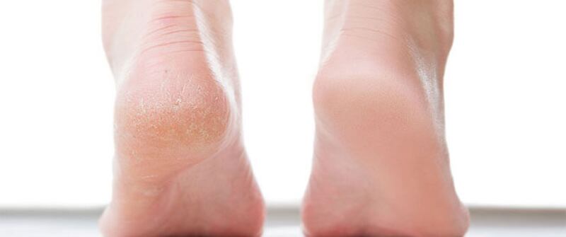 5 علاجات منزلية تخلّصك من تشققات القدمين