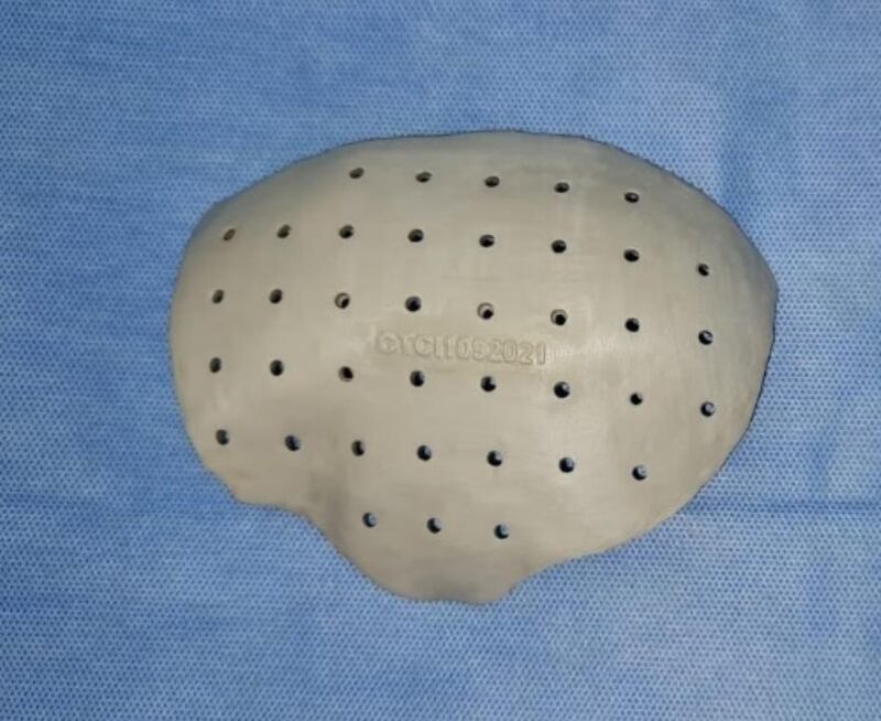 في الجمجمة: إجراء عملية هي الأولى من نوعها في مستشفى خولة