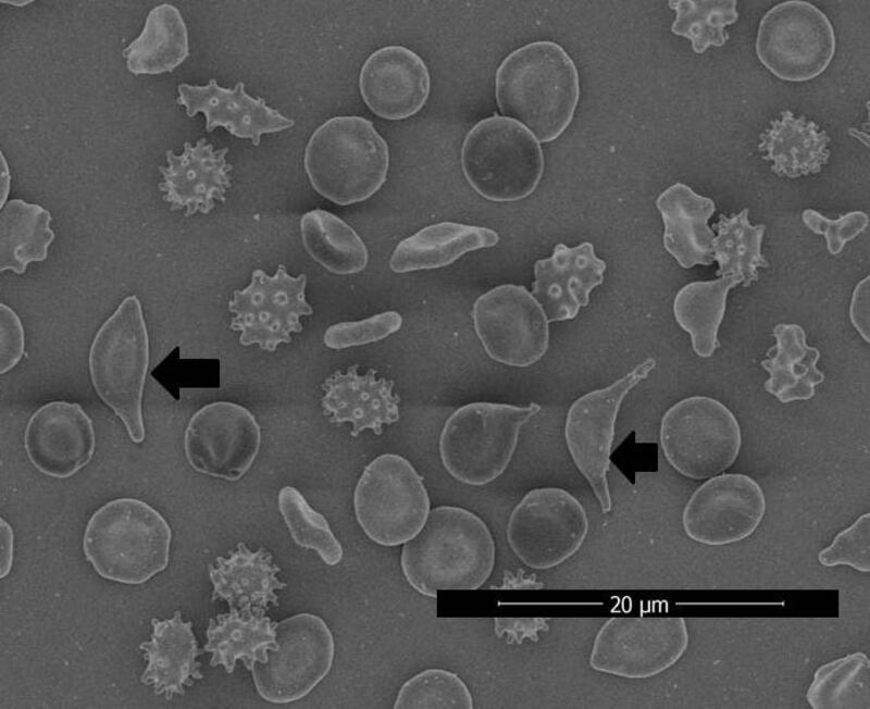 باحثة عُمانية توضح حول طفرة جينية نادرة في الخلايا الحمراء العُمانية