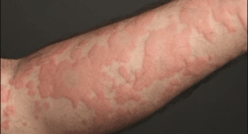 قد يستمر لسنوات وينتشر بين النساء: ماذا تعرف عن مرض الشرى؟