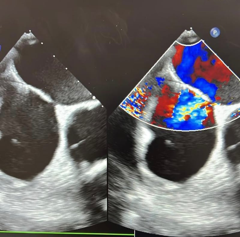 فريق طبي من مستشفى جامعة السلطان قابوس ينجح في علاج مرض نادر
