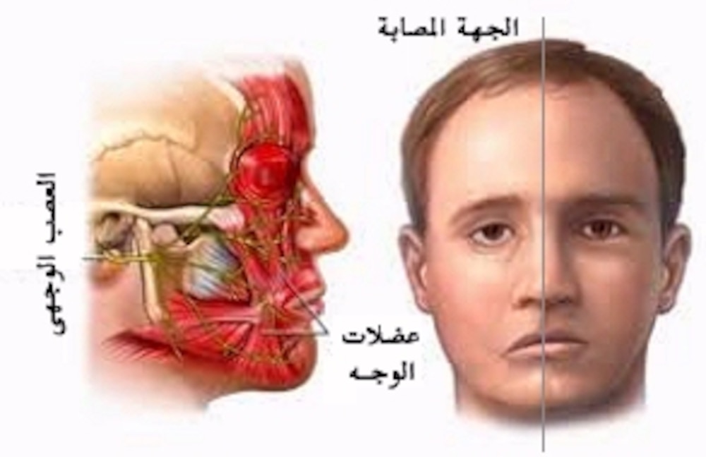 انتبه لهذه الأعراض؛ فقد تكون علامة على شلل العصب الوجهي