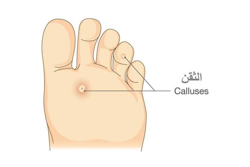 إذا كنت تعاني من مسمار القدم؛ إليك أسبابه وطرق علاجه