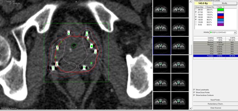 إجراء عملية الأولى من نوعها في مركز السُّلطان قابوس المتكامل لعلاج وبحوث أمراض السرطان
