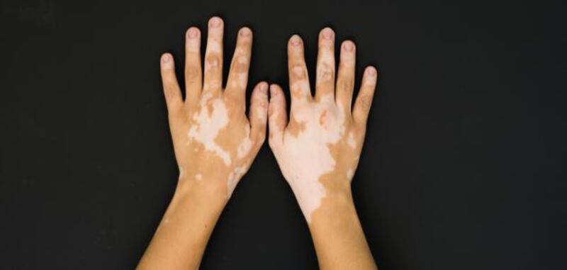 بعد اعتماد أول دواء له: ماذا تعرف عن البهاق ومسبباته؟