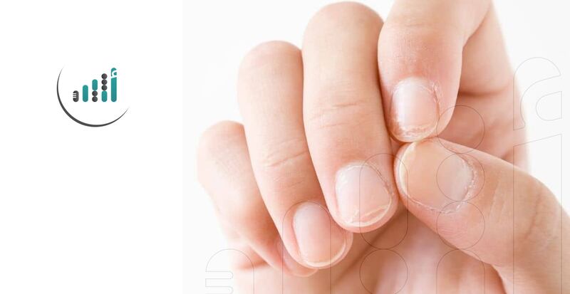 انتبهوا: تشققات الأظافر قد تشير إلى هذه الأمراض 