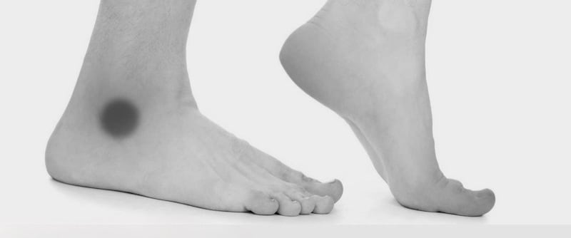 لمن يعاني من اسوداد جوزة القدم: إليك الأسباب وطرق الوقاية منه طبيًا