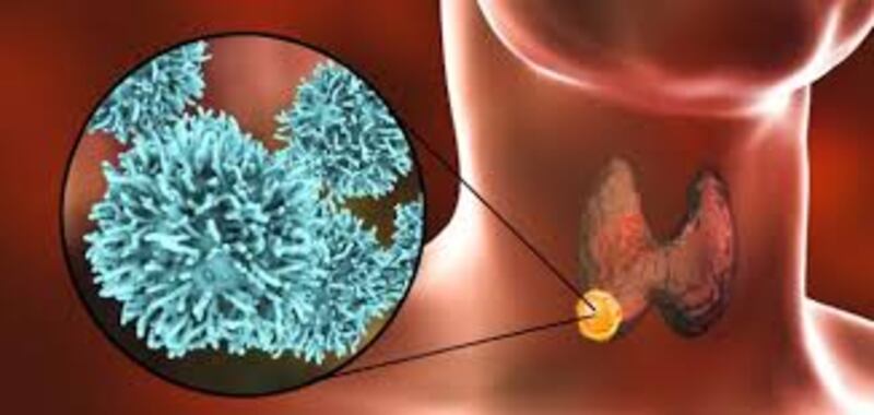 طبيبة توضح حول سرطان الغدة الدرقية وعلاجه